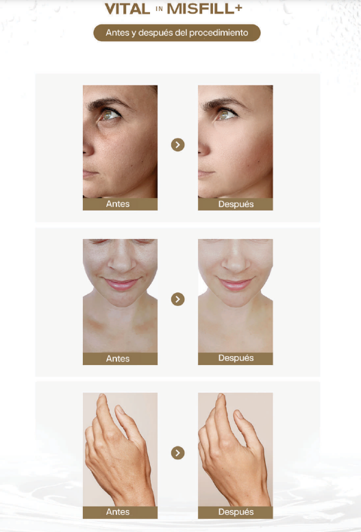 Misfill VITAL – Pack de 5 jeringas de 3ml | Skinbooster con ácido hialurónico para hidratación profunda